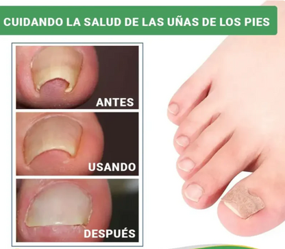 50 Parches FreeNail™ - Correctores para Uñas Encarnadas y Hongos